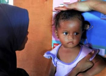 Wasting Memicu Stunting